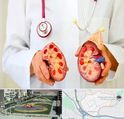 دکتر سنگ کلیه در مرزداران تبریز