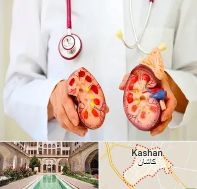 دکتر سنگ کلیه در کاشان