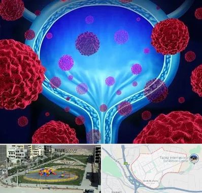 دکتر سرطان مثانه در مرزداران تبریز