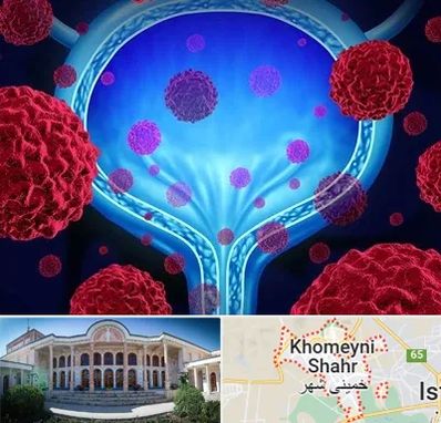 دکتر سرطان مثانه در خمینی شهر