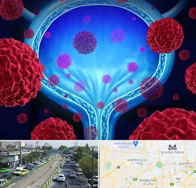دکتر سرطان مثانه در جنوب تهران 