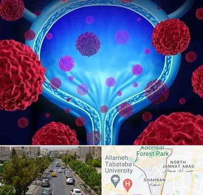 دکتر سرطان مثانه در شهران 