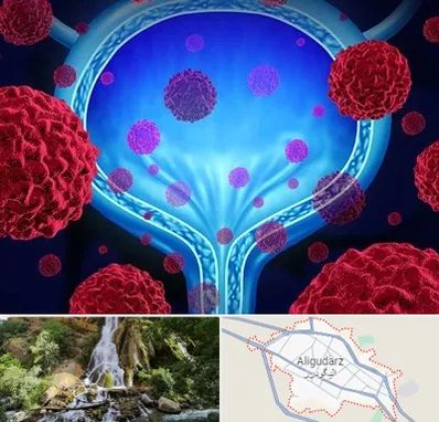 دکتر سرطان مثانه در الیگودرز