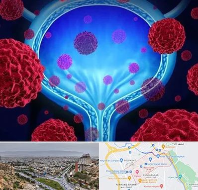 دکتر سرطان مثانه در معالی آباد شیراز 