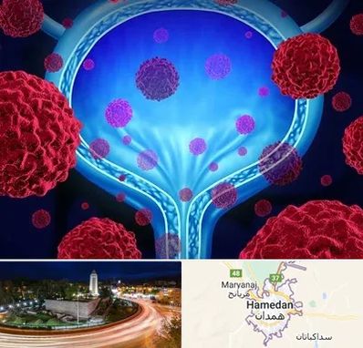 دکتر سرطان مثانه در همدان