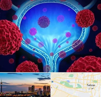 دکتر سرطان مثانه در غرب تهران 