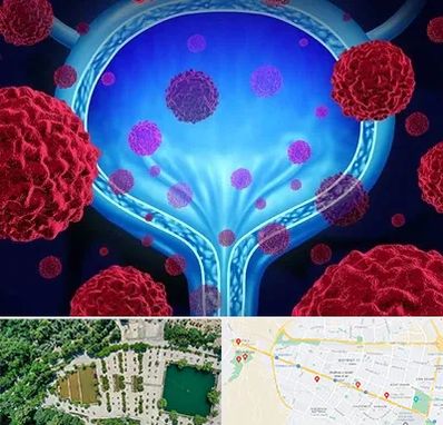 دکتر سرطان مثانه در وکیل آباد مشهد 