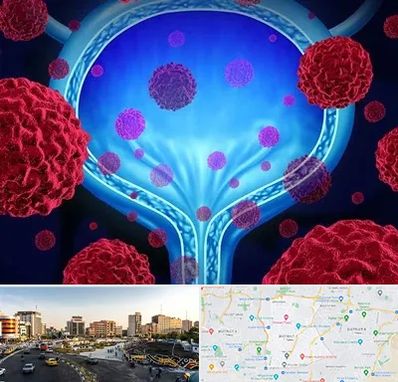 دکتر سرطان مثانه در منطقه 7 تهران 