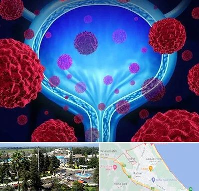 دکتر سرطان مثانه در رودسر