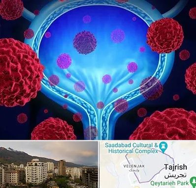 دکتر سرطان مثانه در زعفرانیه 