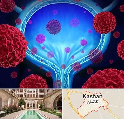 دکتر سرطان مثانه در کاشان