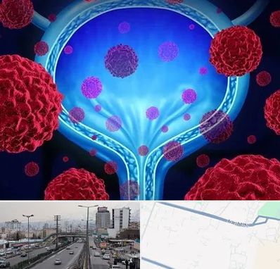 دکتر سرطان مثانه در بلوار ارتش