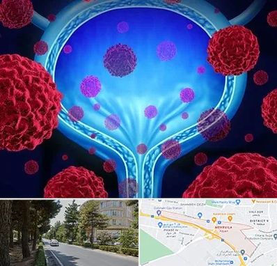 دکتر سرطان مثانه در مهرویلا کرج 