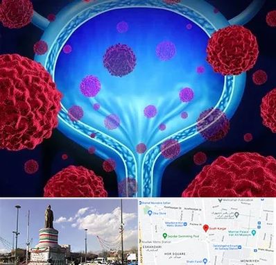 دکتر سرطان مثانه در کارگر جنوبی 