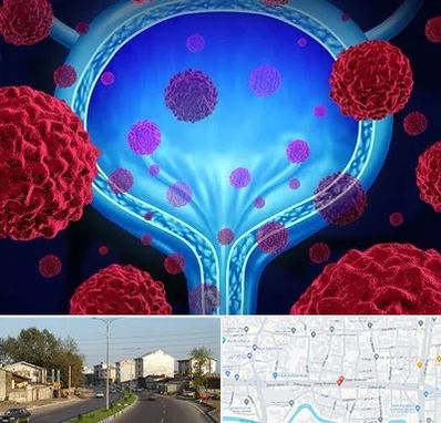 دکتر سرطان مثانه در ضیابری رشت 