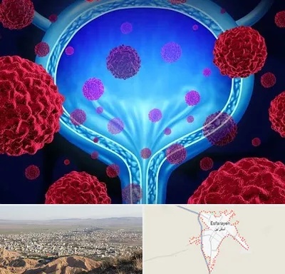 دکتر سرطان مثانه در اسفراین