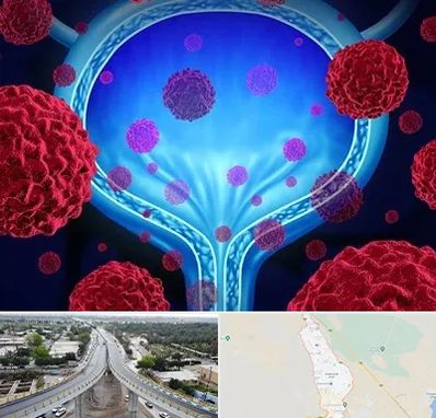 دکتر سرطان مثانه در اندیمشک