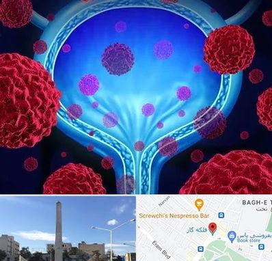 دکتر سرطان مثانه در فلکه گاز شیراز 