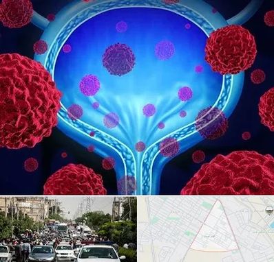 دکتر سرطان مثانه در سیدی مشهد