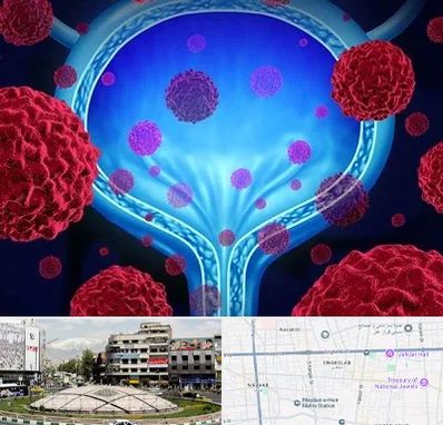 دکتر سرطان مثانه در مرکز تهران