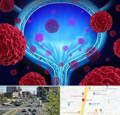 دکتر سرطان مثانه در ستاری 