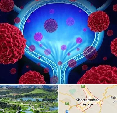 دکتر سرطان مثانه در خرم آباد