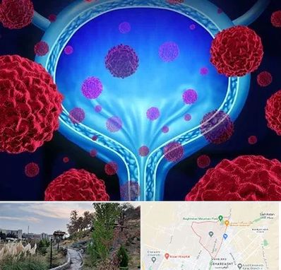 دکتر سرطان مثانه در باغستان کرج 