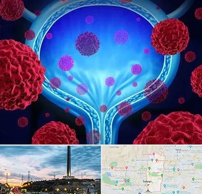 دکتر سرطان مثانه در منطقه 2 تهران 