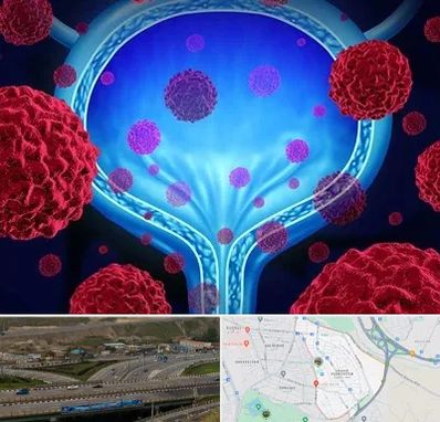 دکتر سرطان مثانه در یاغچیان تبریز