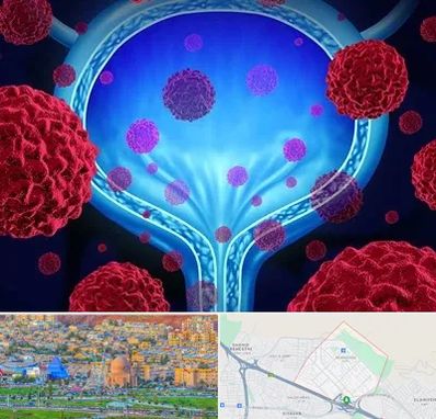 دکتر سرطان مثانه در رشدیه تبریز
