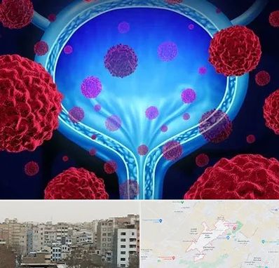 دکتر سرطان مثانه در محمد شهر کرج 