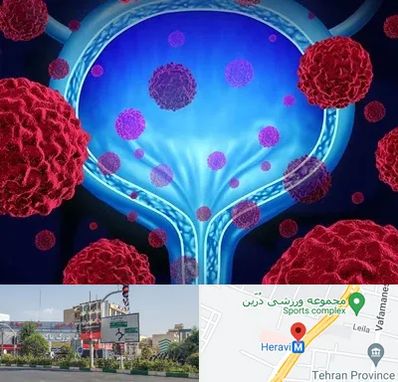 دکتر سرطان مثانه در هروی 