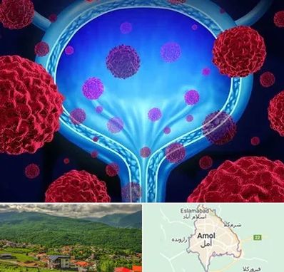 دکتر سرطان مثانه در آمل