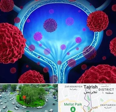 دکتر سرطان مثانه در تجریش 