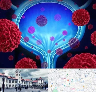 دکتر سرطان مثانه در میدان شهرداری رشت 