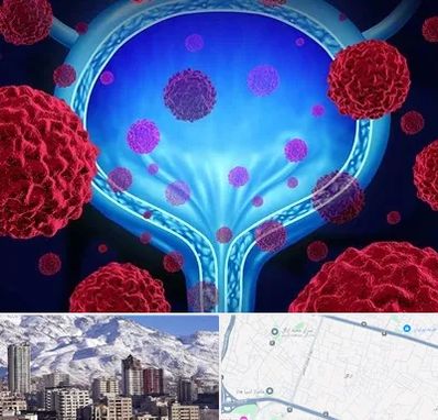 دکتر سرطان مثانه در ازگل