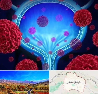 دکتر سرطان مثانه در خراسان شمالی