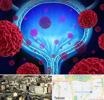 دکتر سرطان مثانه در مرزداران 