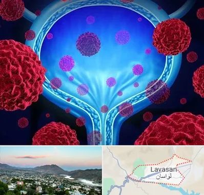 دکتر سرطان مثانه در لواسان