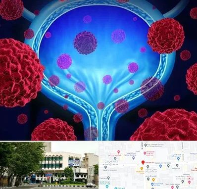 دکتر سرطان مثانه در طالقانی 