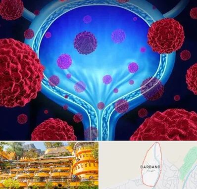 دکتر سرطان مثانه در دربند