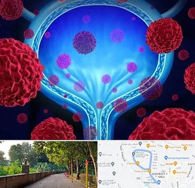 دکتر سرطان مثانه در فلکه گاز رشت 