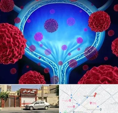 دکتر سرطان مثانه در باجک قم