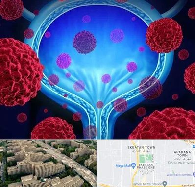 دکتر سرطان مثانه در اکباتان 