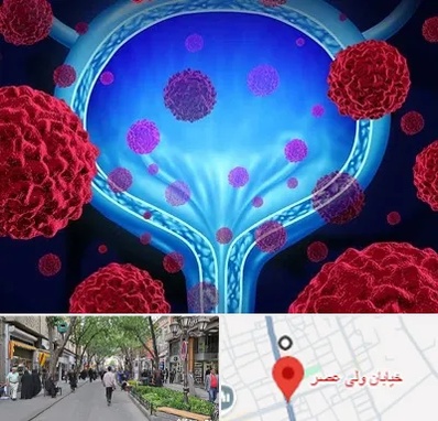 دکتر سرطان مثانه در ولیعصر شهریار