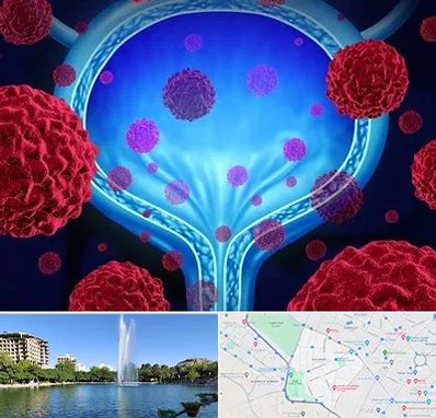 دکتر سرطان مثانه در کوهسنگی مشهد 