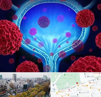 دکتر سرطان مثانه در بلوار کشاورز 