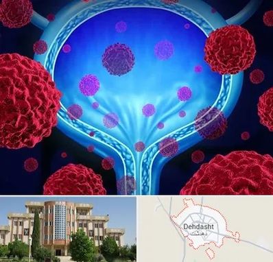 دکتر سرطان مثانه در دهدشت