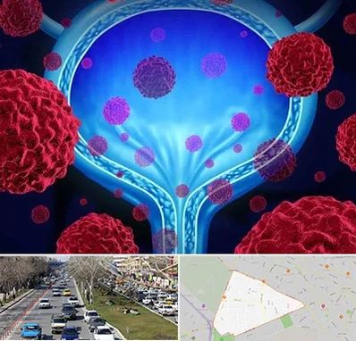 دکتر سرطان مثانه در احمدآباد مشهد 