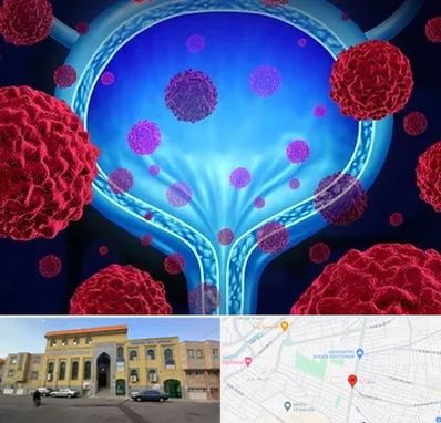 دکتر سرطان مثانه در زنبیل آباد قم